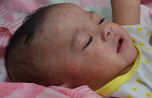 No todo es coronavirus: los pediatras llaman a vacunar contra el sarampión Un bebé con sarampión.