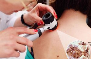 Avanza la VACCIMEL, la vacuna terapéutica argentina contra el cáncer de piel Un avance científico argentino.