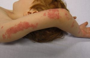 Presentaron en Argentina una nueva vacuna contra el Herpes Zóster el Herpes Zóster es una enfermedad que puede provocar un dolor muy intenso.