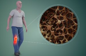 Osteoporosis: una epidemia silenciosa que en los hombres se diagnostica tarde Paradigma. Si bien la osteoporosis es una afección relacionada con las mujeres, del total de fracturas de huesos atribuidos a esta enfermedad, el 40% son sufridas por varones.