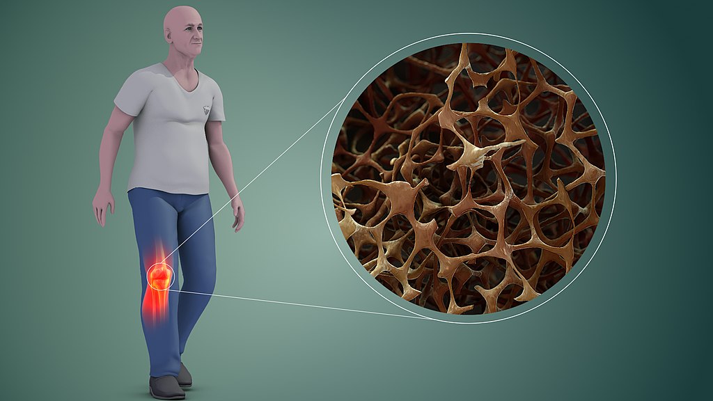1024px-Osteoporosis_in_Bones Paradigma. Si bien la osteoporosis es una afección relacionada con las mujeres, del total de fracturas de huesos atribuidos a esta enfermedad, el 40% son sufridas por varones.